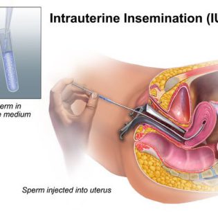 Ovulation-IUI